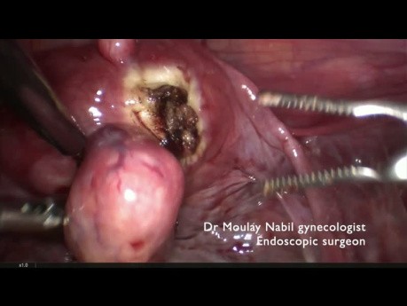 Myomectomy for Huge 12cm Type 7 FIGO Myoma