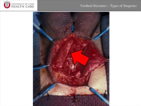 Urethral Strictures