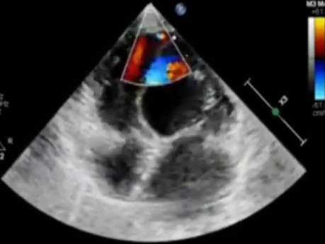 A Small (Restrictive) Apical Ventricular Septum Defect VSD-echocardiography