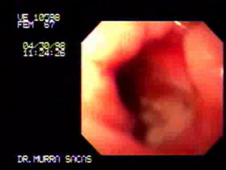 Adenocarcinoma of the Pylorus - Endoscopy