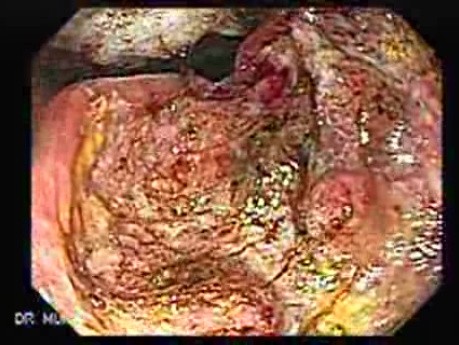 Adenocarcinoma of the Antrum (1 of 5)