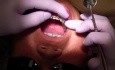 Orthodontic Case #2 - Treatment Review At 6 Months Of Fixed Appliance Therapy
