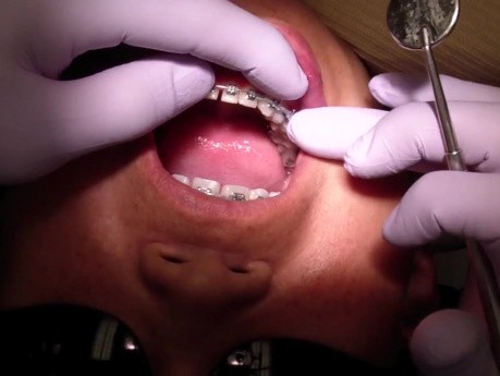 Orthodontic Case #2 - Treatment Review At 6 Months Of Fixed Appliance Therapy
