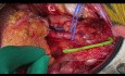 End-to-end Anastomosis Inferior Epigastric Artery to Lower Polar Artery