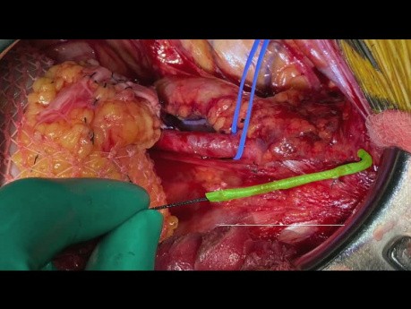 End-to-end Anastomosis Inferior Epigastric Artery to Lower Polar Artery