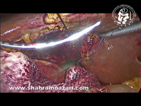 Carelessness and Damage to the Liver Gallbladder Bed Vessel