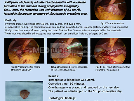 Laparoscopic Wedge Resection of Gastric Gastrointestinal Stromal Tumor (GIST)