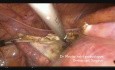 Hysterectomy for Enlarged Uterus (Fully Narrated Technique)