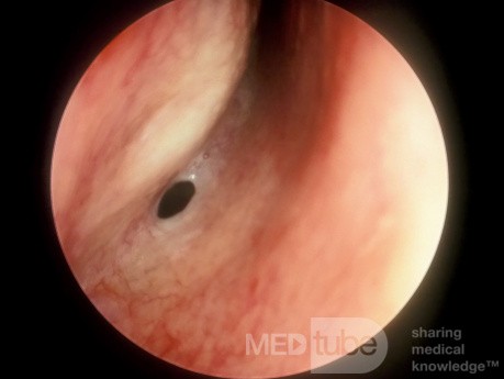 The Sphenoid Sinus Ostium [right]