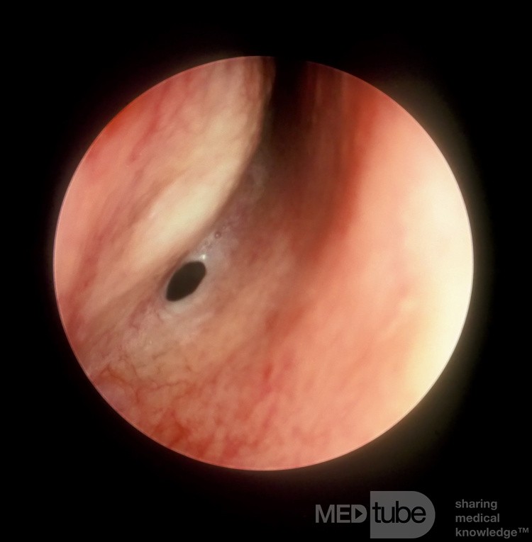 The Sphenoid Sinus Ostium [right]