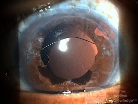 Pupil Supported Lens Exchanged to Iris Claw and DSEK 