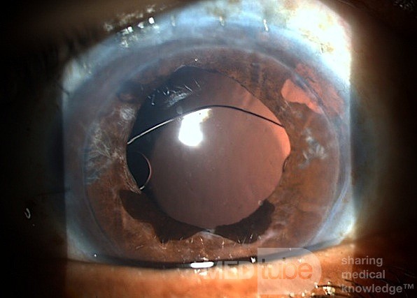 Pupil Supported Lens Exchanged to Iris Claw and DSEK 