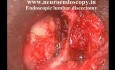 Endoscopic Lumbar Discectomy 