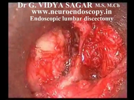 Endoscopic Lumbar Discectomy 