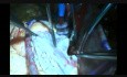 Superior Septal Approach to the Mitral Valve