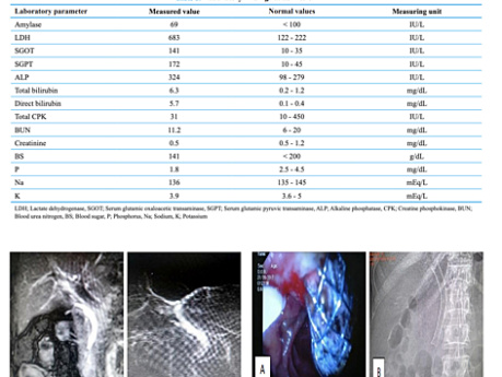 An Unusual Treatment for Massive and Refractory Bleeding after Endoscopic Retrograde Cholangiopancreatography