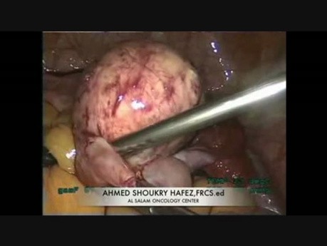 Laparoscopic Ovarian Cystectomy