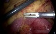 Laparoscopic Small Bowel Obstruction, ICG