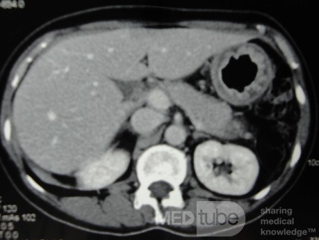 Endoscopy of Scirrhous Gastric Carcinoma involving the entire Fundus, Body and the Antrum (19 of 47)