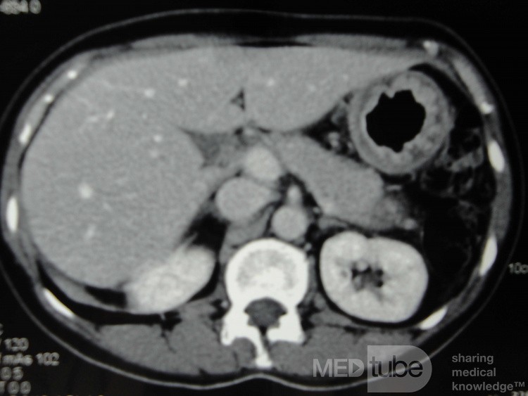 Endoscopy of Scirrhous Gastric Carcinoma involving the entire Fundus, Body and the Antrum (19 of 47)