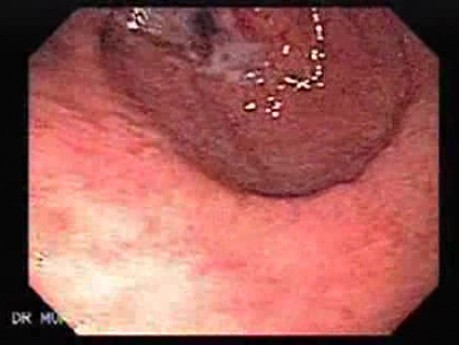 Adenocarcinoma of the Pre-pyloric Antrum (1 of 3)