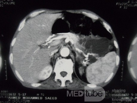 Pancreas cancer - 2
