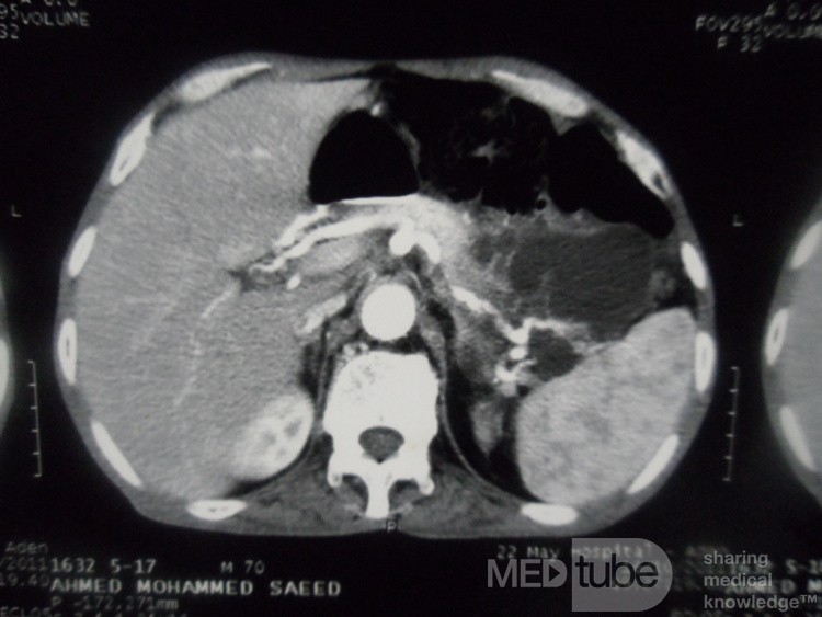 Pancreas cancer - 2