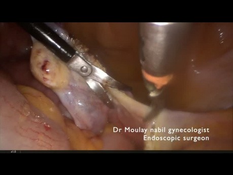 Protected adnexectomy for huge ovarian  cyst