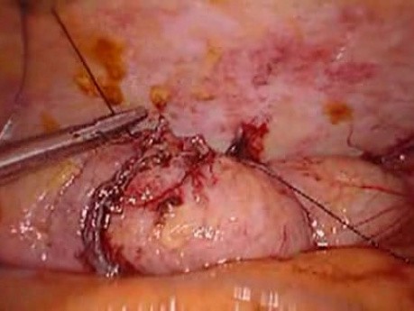 Colonic Perforation With Peritonitis - Laparoscopy (10 of 46)