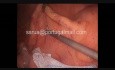 Splenic Angle Dissection