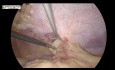Laparoscopic Incisional Hernia Repair by IPOM Plus Technique and Titanized Mesh
