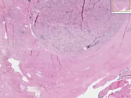 Prostate - Adenocarcinoma - Histopathology