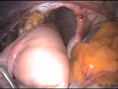 From Conventional Laparoscopy to LESS Surgery The Journey For GERD