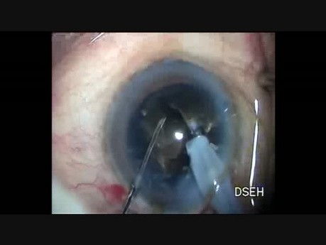 Oval Rhexis in Hard Cataract and PCR Management