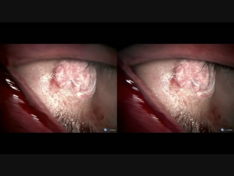Dermoid Medial Canthus - Bleeding Problem