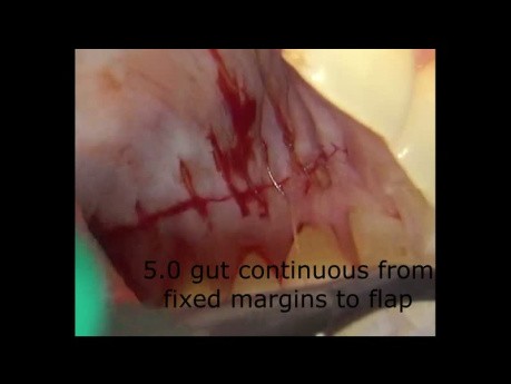 Cosmetic Connective Tissue Grafting for Recession