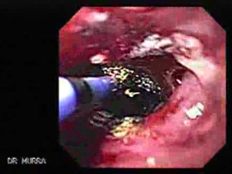 Adenocarcinoma of the Cardia and Carcinoma Epidermoid of the Larynx (10 of 26)