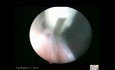 TVL Fulguration With Bipolar 