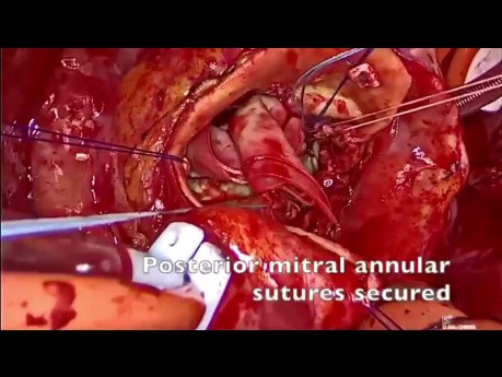 Aorto Mitral Continuity Reconstruction with Bovine Pericardial Patch and Replacement Mitral and Aortic Valve