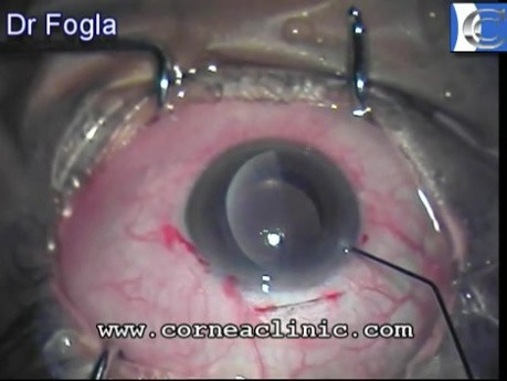 Donor disc in endothelial keratoplasty