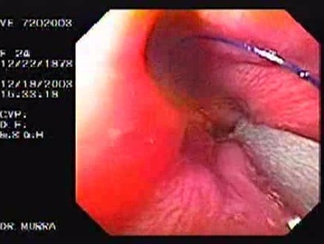 Flexible Endoscopic Suturing - Endoscopic Anti-Reflux Procedure