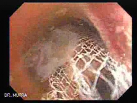 Colonoscopic Polypectomy (18 of 18)