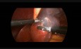 Laparoscopic Unroofing of Liver Cyst in 14 Year Old Boy