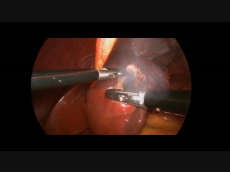Laparoscopic Unroofing of Liver Cyst in 14 Year Old Boy