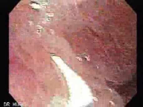 Multilobulated Gastric Polyp (1 of 20)