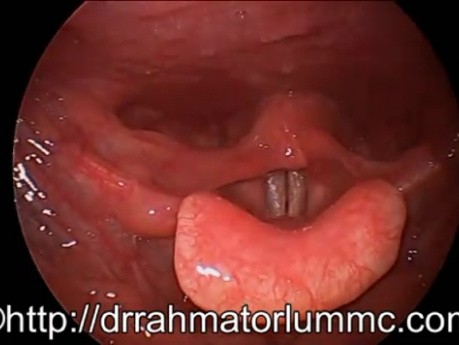 Overriding Tip of the Right Arytenoid