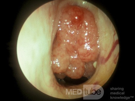 Enlarged Adenoids