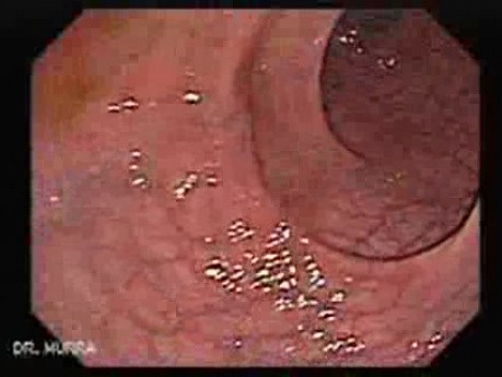 Histoplasmosis and Condyloma Accuminata (4 of 5)