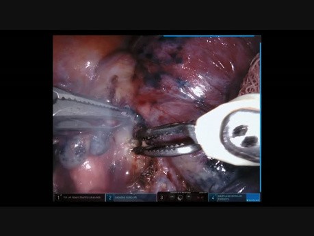 Right Lower Lobe - Robotic Lobectomy