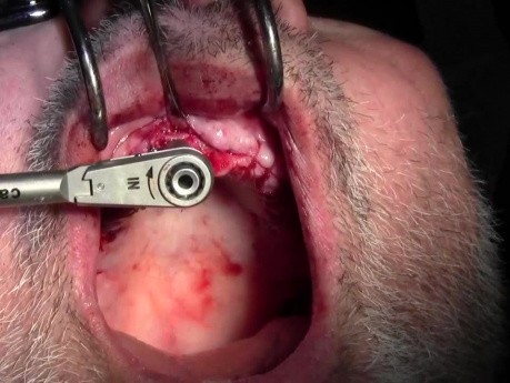 Re-Entry Placement - Implant Surgery, #8 Site